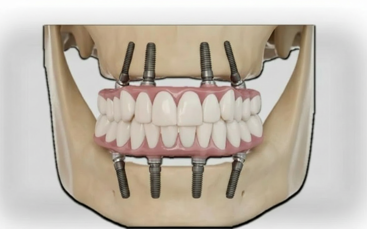Prótese Total Sobre Implantes (Protocolo)